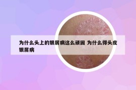 为什么头上的银屑病这么顽固 为什么得头皮银屑病