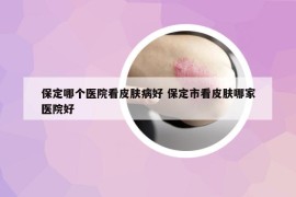 保定哪个医院看皮肤病好 保定市看皮肤哪家医院好