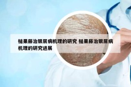 槌果藤治银屑病机理的研究 槌果藤治银屑病机理的研究进展