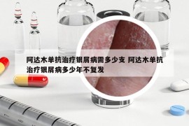 阿达木单抗治疗银屑病需多少支 阿达木单抗治疗银屑病多少年不复发