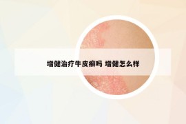 增健治疗牛皮癣吗 增健怎么样