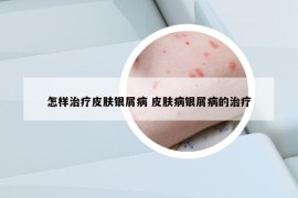 怎样治疗皮肤银屑病 皮肤病银屑病的治疗