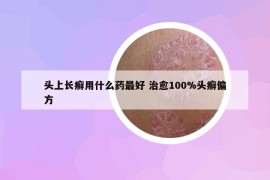 头上长癣用什么药最好 治愈100%头癣偏方