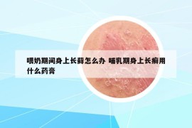 喂奶期间身上长藓怎么办 哺乳期身上长癣用什么药膏