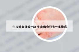 牛皮癣会只长一块 牛皮癣会只有一小块吗