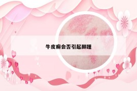 牛皮癣会否引起脚踵