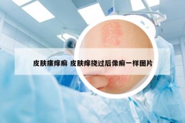 皮肤瘙痒癣 皮肤痒挠过后像癣一样图片
