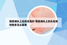 银屑病头上在脱皮是好 银屑病头上的头皮屑特别多怎么回事