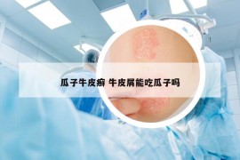 瓜子牛皮癣 牛皮屑能吃瓜子吗