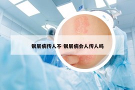 银屑病传人不 银屑病会人传人吗