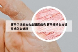 怀孕了还能治头皮银屑病吗 怀孕期间头皮银屑病怎么处理