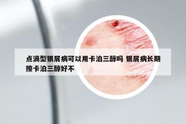 点滴型银屑病可以用卡泊三醇吗 银屑病长期擦卡泊三醇好不