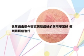 银屑病去郑州哪家医院最好的医院哪家好 郑州银屑病治疗
