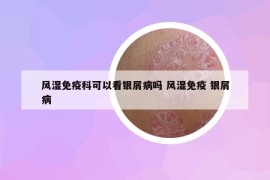 风湿免疫科可以看银屑病吗 风湿免疫 银屑病