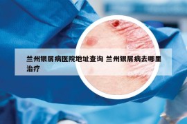 兰州银屑病医院地址查询 兰州银屑病去哪里治疗