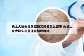 头上大块头皮屑结痂又痒是怎么回事 头皮上有大块头皮屑还有结痂痒痒
