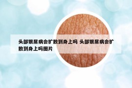 头部银屑病会扩散到身上吗 头部银屑病会扩散到身上吗图片