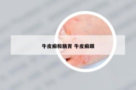 牛皮癣和肠胃 牛皮癣跟
