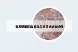 束发型银屑病 束发型银屑病能治好吗