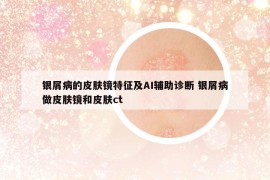 银屑病的皮肤镜特征及AI辅助诊断 银屑病做皮肤镜和皮肤ct