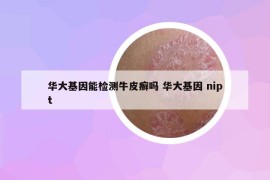 华大基因能检测牛皮癣吗 华大基因 nipt