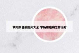掌跖脓包病图片大全 掌跖脓疱病怎样治疗