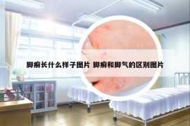 脚癣长什么样子图片 脚癣和脚气的区别图片