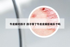 牛皮癣对孩子 孩子得了牛皮皮癣影响长个吗