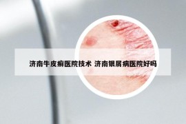 济南牛皮癣医院技术 济南银屑病医院好吗