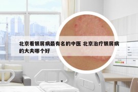 北京看银屑病最有名的中医 北京治疗银屑病的大夫哪个好
