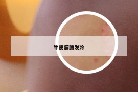 牛皮癣腰发冷