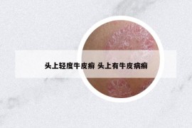 头上轻度牛皮癣 头上有牛皮病癣