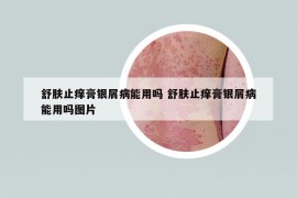 舒肤止痒膏银屑病能用吗 舒肤止痒膏银屑病能用吗图片