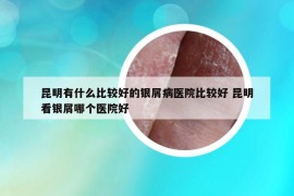 昆明有什么比较好的银屑病医院比较好 昆明看银屑哪个医院好