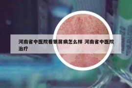 河南省中医院看银屑病怎么样 河南省中医院治疗