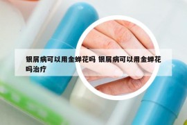 银屑病可以用金蝉花吗 银屑病可以用金蝉花吗治疗