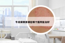 牛皮癣银屑病在哪个医院能治好