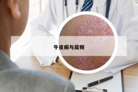 牛皮癣与尿频