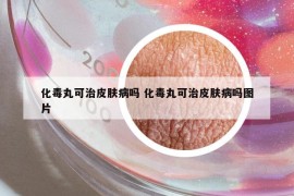 化毒丸可治皮肤病吗 化毒丸可治皮肤病吗图片