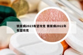 银屑病2023有望攻克 银屑病2022年有望攻克