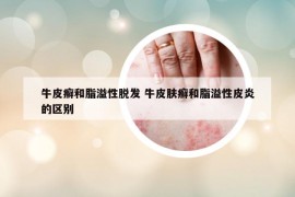 牛皮癣和脂溢性脱发 牛皮肤癣和脂溢性皮炎的区别
