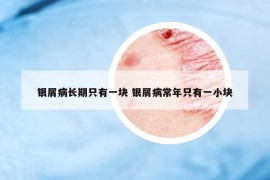 银屑病长期只有一块 银屑病常年只有一小块