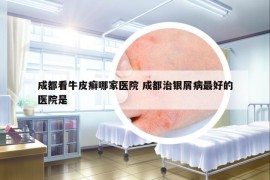 成都看牛皮癣哪家医院 成都治银屑病最好的医院是