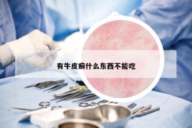 有牛皮癣什么东西不能吃