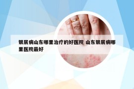 银屑病山东哪里治疗的好医院 山东银屑病哪里医院最好