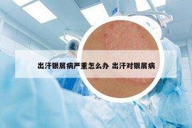 出汗银屑病严重怎么办 出汗对银屑病
