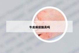 牛皮癣尿酸高吗