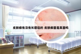 皮肤癣有没有长蘑菇的 皮肤癣菌是真菌吗