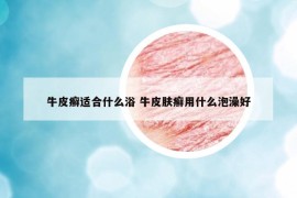 牛皮癣适合什么浴 牛皮肤癣用什么泡澡好
