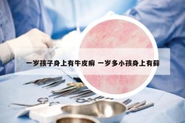 一岁孩子身上有牛皮癣 一岁多小孩身上有藓